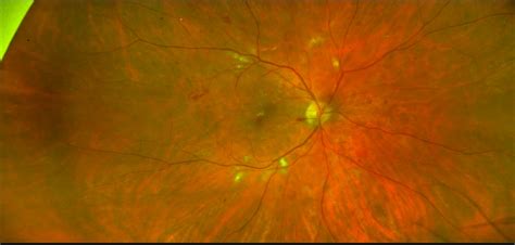 Diabetic Eye Exams Envision Eyecare