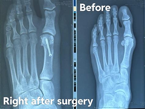 Bunions: Treatment, causes, non-surgical and surgical approaches
