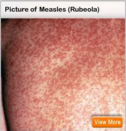 Measles Pictures, Treatment, Causes, Symptoms & MMR Vaccine