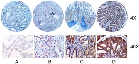 Immunohistochemical Staining For Her 2neu Expression In Tumor Samples Download Scientific