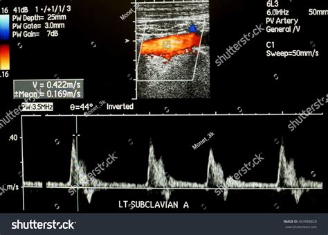 Subclavian Artery Waveform Ultrasound
