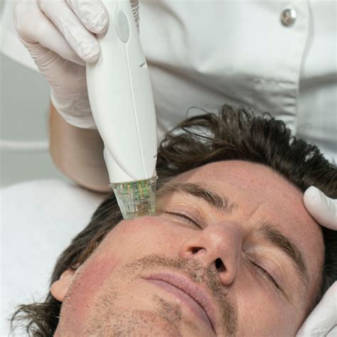 Microneedling Rf Behandeling