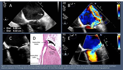 Atrial Functional Mitral Regurgitation In A Patient With Long Standing Persistent Atrial