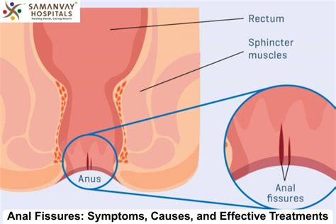 Anal Fissures Explained Causes Symptoms Treatments