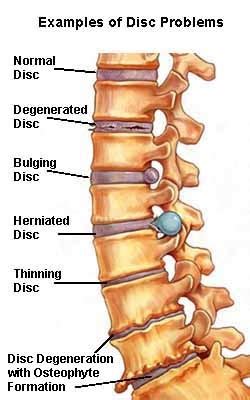 Lumbar Spondylosis - Physiopedia