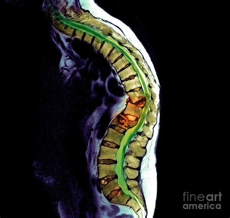 Secondary Bone Cancer Photograph by Simon Fraser/science Photo Library