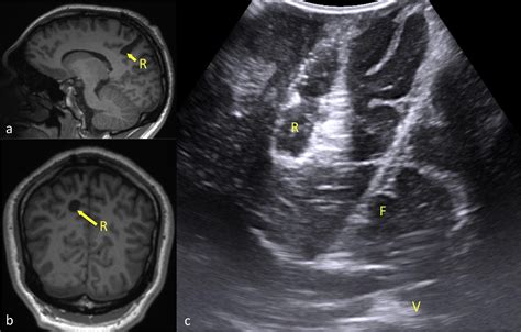 Intraoperative Definition Of Bottom Of Sulcus Dysplasia Using