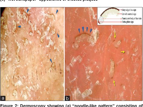 Figure 2 From Dermoscopy Of Crusted Scabies Revisiting The New And Old