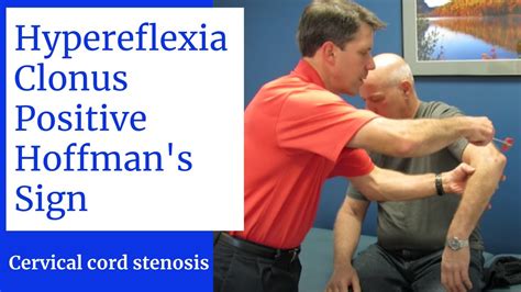 Hyperreflexia, Clonus, Positive Hoffman's Sign- Central Cervical Spine Stenosis - YouTube