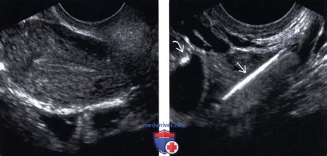 Методы обследования внутриматочной спирали (ВМС)