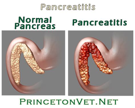 Qu Es La Pancreatitis Health Life Media