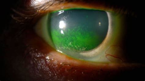 Keratoconjunctivitis sicca, causes, symptoms, diagnosis, treatment & prognosis