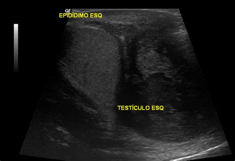 Paratesticular Rhabdomyosarcoma Image