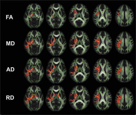Sex Differences In White Matter Alterations Following Repetitive