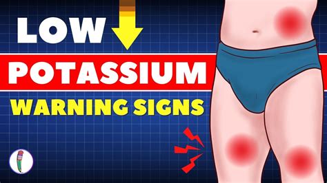 Signs Of Low Potassium And Natural Treatment Potassium Deficiency Hypokalemia Youtube