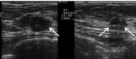 longitudinal grayscale ultrasound images show  irregular hypoechoic