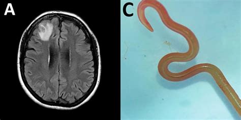 Worm plucked from brain of woman in Australia