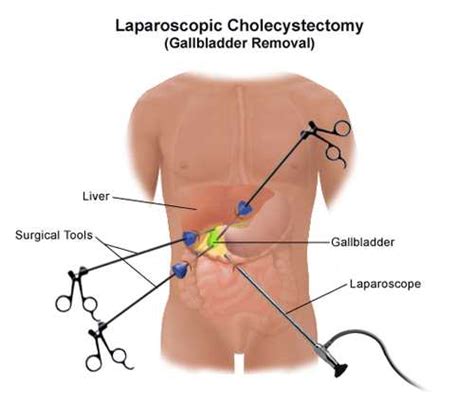 Laparoscopic Cholecystectomy Treatment in Pune | Presize Clinic