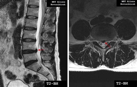 МРТ поясничного отдела позвоночника в Рубцовске – цены в клинике «МРТ ...
