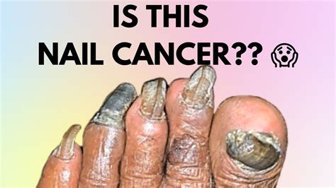 Nail Melanoma Symptoms - Nail Ftempo