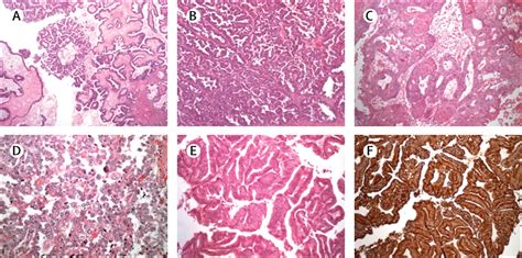 Ovarian Cancer The Lancet