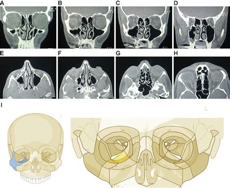 comprehensive aocmf classification system orbital fractures