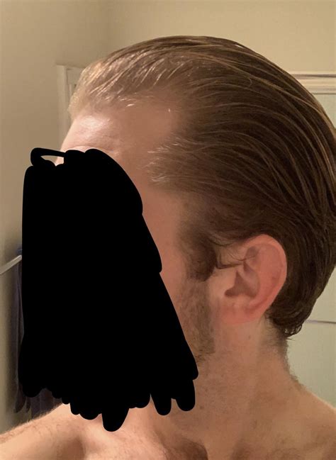 Topical Finasteride And Minoxidil 6 Months Results R Tressless