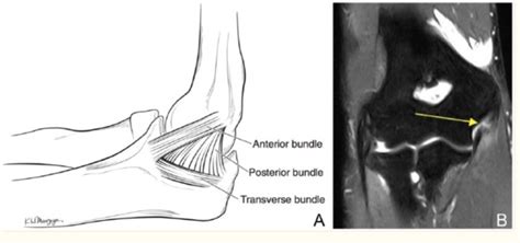 UCL Injuries in Quarterbacks - Sports Medicine Review