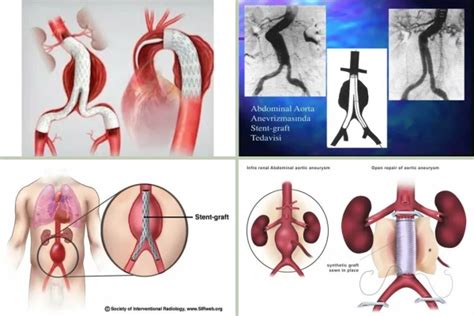 Aort anevrizmasına STENA Stent tedavisi Haber Sitesi