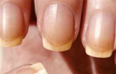 What Causes Yellow Fingernails Lovely Nails Blog