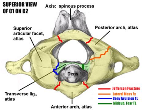 Best 12 Cervical Epidural Injection with Contralateral Oblique View