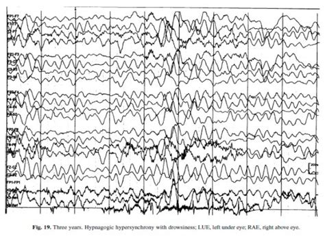 Normal awake and sleep EEG