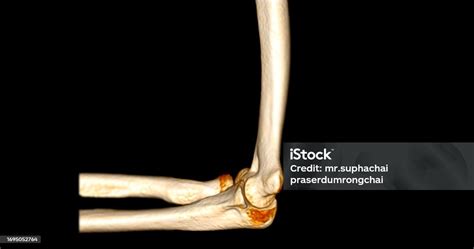 Ct Scan Of Elbow Joint 3d Rendering Stock Photo - Download Image Now