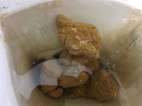 White mucus in my stool? (Warning - Stool photos) at Candida