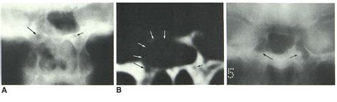 Figure 14 from pathologic findings. The radiology of the pterygoid ...