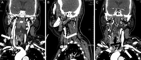 Ct Images Of Internal Jugular Vein Thrombosis Post Contrast Neck Ct