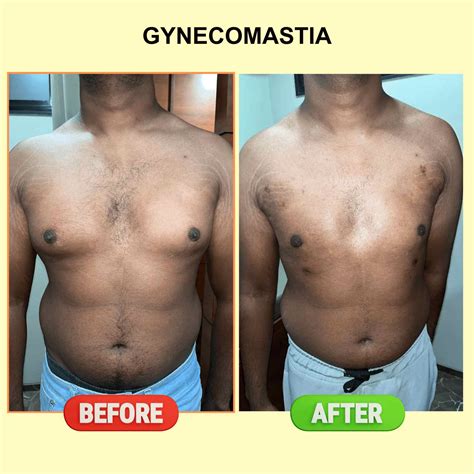 Introduction Understanding Chest Fat And Gynecomastia