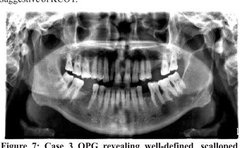 Figure From Keratocystic Odontogenic Tumor Kcot A Report Of Three