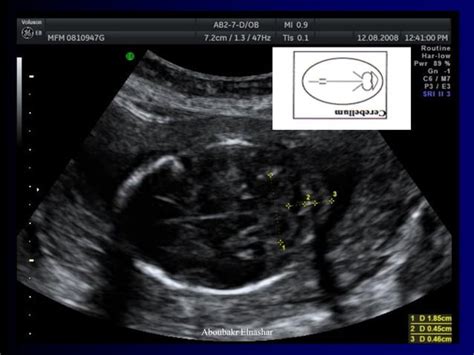 Ultrasonography Of Congenital Fetal Defects