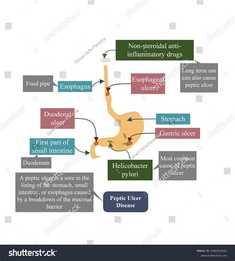 Peptic Ulcer Common Causes 库存插图 2265767567 | Shutterstock