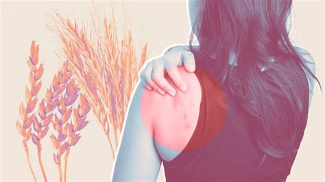 What Is Celiac Disease Rash? Here's What to Know