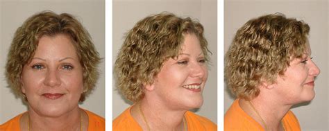 Face Neck Lift Doctor Chettawut Facial Cosmetic Surgery Gallery Dr Chettawut Sex Reassignment