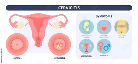 Vektorov Grafika Douche Vagina Odor Clean Blood Flora Ectopic Yeast Bacterial Pelvic Genitals