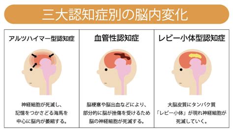 認知症の検索結果 Yahooきっず検索