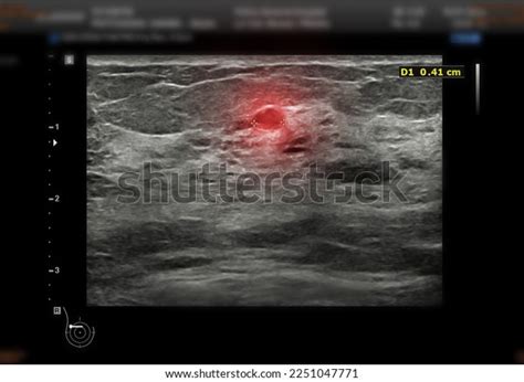 Ultrasound Breast Patient After Mammogram Diagnonsis Stock Illustration