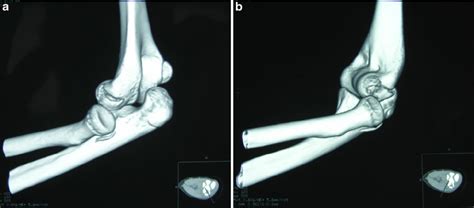 Computed Tomography Scan Of The Left Elbow Demonstrating The Fracture