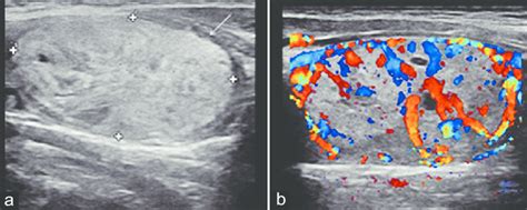 Benign thyroid adenoma in a 42‑year‑old female patient. Transverse ...