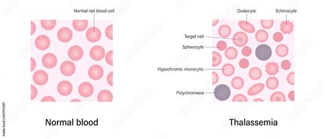 Thalassemia Blood Smear The Difference Of Thalassemia And Normal Blood