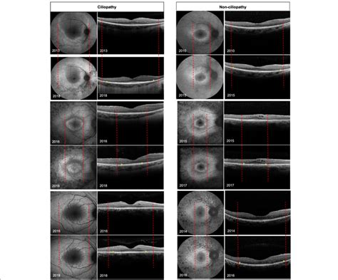 Structural measurements of 6 patients. 3 ciliopathy (right column) and ...