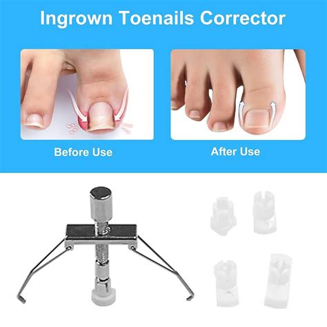 Ingrown Toenail Treatment Kit with 12 Braces, 50 Nail Patches, and